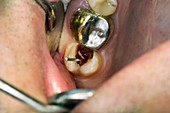 Root canal dental surgery