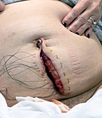 Abdominal surgical wound with sutures