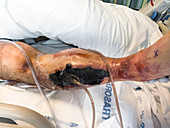 Woundcare for compartment syndrome