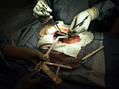 Stapler use during intestinal surgery