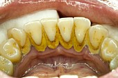 Teeth covered with plaque and tartar