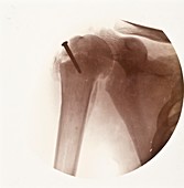 Shoulder screw X-ray,early 20th century