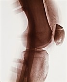 Broken leg X-ray,early 20th century
