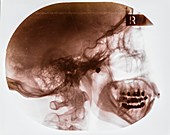 Skull X-ray,early 20th century