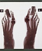 Feet disorder X-ray,early 20th century