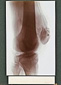 Knee X-ray,early 20th century