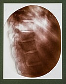Spine X-ray,early 20th century