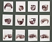 Dental X-rays,early 20th century