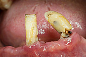 Broken canine tooth