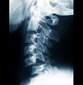 Dislocated vertebra in whiplash injury