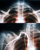 Extra rib,X-rays