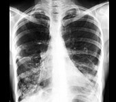 Tuberculosis of the lung,X-ray