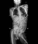 Spinal deviation in polio,X-ray