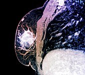 Breast cancer,MRI