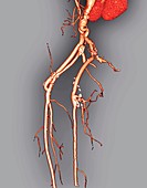 Arterial bypass,3D CT scan
