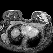 Secondary breast cancer,MRI