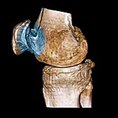 Osteoarthritis of the knee,3D CT scan