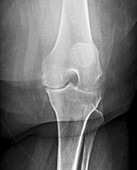 Osteoarthritis of the knee,X-ray