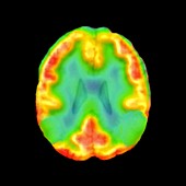 Brain in Alzheimer's disease,SPECT