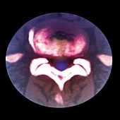 Spinal disc protrusion,CT scan