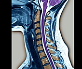 Normal cervical vertebra,MRI scan