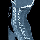 Spinal fracture,CT scan