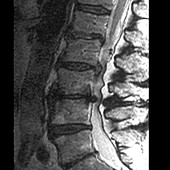 Slipped disc in spinal stenosis,X-ray