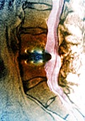 Spinal disc replacement,MRI
