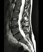 Spinal arachnoiditis,MRI