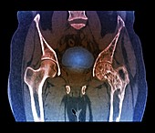 Hips in Paget's disease,CT scan
