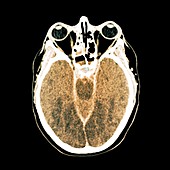 Brain death following cardiac arrest,CT
