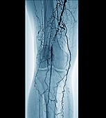 Peripheral vascular disease in diabetes