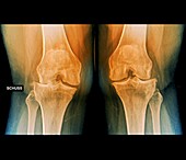 Varus deformity in osteoarthritis,X-ray
