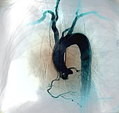 Aortic arch,X-ray