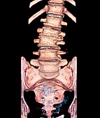 Spinal compression fracture,3D CT scan