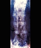 Spine in ankylosing spondylitis,X-ray