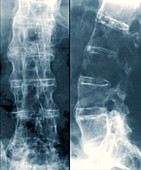 Spine in ankylosing spondylitis,X-ray