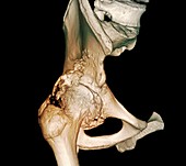 Osteoarthritis of the hip,3D CT scan