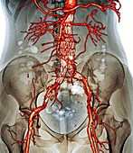 Stent in carotid aneurysm,3D CT scan