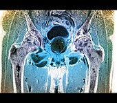 Hairy cell leukaemia,MRI