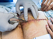 Removing surgical staples
