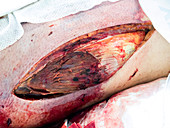 Fasciotomy in compartment syndrome