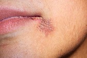 Formocresol skin burn in dentistry