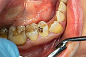 Root canal pulp extraction from premolar
