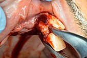 Incisor tooth extraction