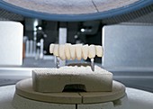 Dental bridge construction