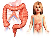 Mega colon of a child,illustration