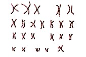 Down's syndrome karyotype,illustration