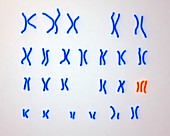 Edward's syndrome karyotype,illustration