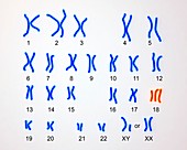 Edward's syndrome karyotype,illustration